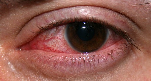 Contact Lens Acute Red Eye
